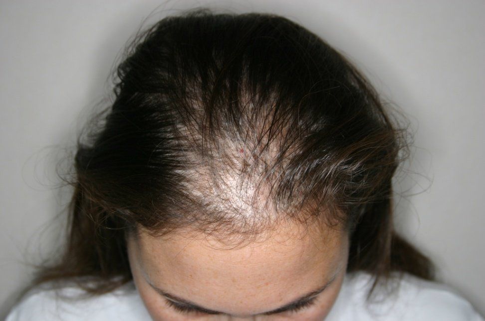 Как избежать выпадения волос - что такое алопеция и почему выпадают волосы от школа красоты Dellon